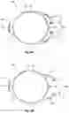 Fig. 07 - Modular intraocular lens designs, tools and methods