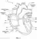 Fig. 02 - Compact prosthetic heart valve device