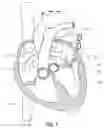 Fig. 05 - Delivery system for heart valve replacement