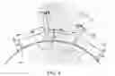 Fig. 07 - Absorbable intravascular devices that shorten upon expansion creating space for vascular movement