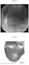 Fig. 12 - INJECTABLE HYDROGELS FOR LOCAL DELIVERY TO THE HEART