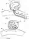 Fig. 04 - ANEURYSM OCCLUSION DEVICE