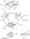 Fig. 05 - ANEURYSM OCCLUSION DEVICE