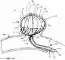 Fig. 06 - ANEURYSM OCCLUSION DEVICE