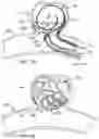Fig. 10 - ANEURYSM OCCLUSION DEVICE