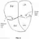Fig. 07 - SYSTEMS AND METHODS FOR HEART VALVE REPAIR