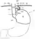 Fig. 01 - Apparatus for treating gerd