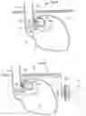 Fig. 07 - Apparatus for treating gerd