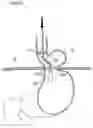 Fig. 22 - Apparatus for treating gerd