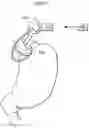 Fig. 43 - Apparatus for treating gerd