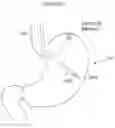 Fig. 71 - Apparatus for treating gerd