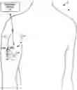 Fig. 01 - Electrical stimulation device with minimally invasive delivery