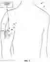 Fig. 02 - Electrical stimulation device with minimally invasive delivery