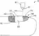 Fig. 01 - SYSTEMS AND METHODS FOR LASER-ASSISTED TOPICAL TREATMENT OF NAIL FUNGAL INFECTIONS