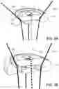 Fig. 06 - Knotless orthopedic stabilization system