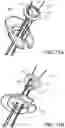 Fig. 08 - Knotless orthopedic stabilization system