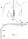 Fig. 02 - Stimulation lead with electrodes configured for sensing and stimulation over a partial circumference