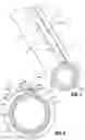 Fig. 07 - Surgical access device including alternating cutout fluid flow pathway for anchor inflation and deflation