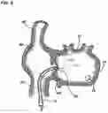 Fig. 09 - Transseptal crossing system for single pass large bore access