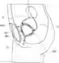 Fig. 01 - Biomimetic artificial bladder and method for controlling same