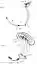 Fig. 06 - IMPLANT FOR IMPROVING COAPTATION OF AN ATRIOVENTRICULAR VALVE