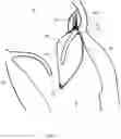 Fig. 08 - IMPLANT FOR IMPROVING COAPTATION OF AN ATRIOVENTRICULAR VALVE
