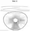 Fig. 04 - ONE PIECE OSTOMY POUCH ENHANCEMENTS