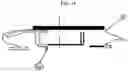 Fig. 14 - ONE PIECE OSTOMY POUCH ENHANCEMENTS
