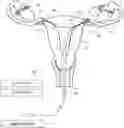 Fig. 01 - Systems and methods for permanent female contraception