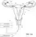 Fig. 02 - Systems and methods for permanent female contraception