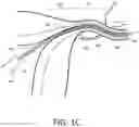 Fig. 04 - Systems and methods for permanent female contraception
