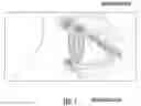 Fig. 02 - DEVICES, SYSTEMS, AND METHODS FOR THE TREATMENT OF CLOGGED GLANDS OF THE EYE