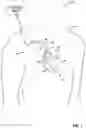 Fig. 02 - HEART RATE BASED CONTROL OF CARDIAC RESYNCHRONIZATION THERAPY