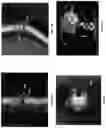 Fig. 43 - Systems, methods, and devices for medical image analysis, diagnosis, risk stratification, decision making and/or disease tracking