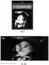Fig. 28 - Systems, methods, and devices for medical image analysis, diagnosis, risk stratification, decision making and/or disease tracking