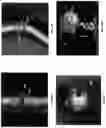 Fig. 43 - Systems, methods, and devices for medical image analysis, diagnosis, risk stratification, decision making and/or disease tracking