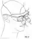 Fig. 06 - LOUPE HAVING ENHANCED SHIELDING