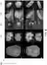 Fig. 09 - Methods, apparatuses, and systems for creating 3-dimensional representations exhibiting geometric and surface characteristics of brain lesions