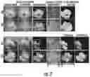 Fig. 03 - Methods for automated detection of cervical pre-cancers with a low-cost, point-of-care, pocket colposcope