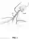 Fig. 02 - BREAKABLE SAMPLE COLLECTION SWAB