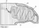 Fig. 37 - Micro-macro endovascular occlusion device and methodology
