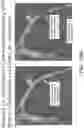 Fig. 167 - Medical devices comprising detachable balloons and methods of manufacturing and use