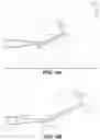Fig. 06 - Instruments and methods for subperiosteal tunneling and related surgical procedures