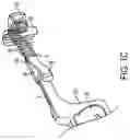Fig. 03 - Orthodontic molar distalizer