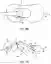 Fig. 13 - Orthodontic molar distalizer