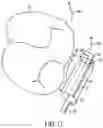 Fig. 18 - Orthodontic molar distalizer