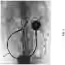 Fig. 06 - Ureteral bypass devices and procedures