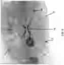Fig. 07 - Ureteral bypass devices and procedures