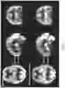 Fig. 09 - METHOD FOR IMPROVING BLOOD FLOW OF THE CEREBRAL CORTEX
