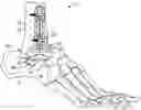 Fig. 01 - ARTHROPLASTY IMPLANT SYSTEMS FOR GENERATING AND APPLYING DYNAMIC COMPRESSION